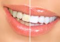 Отбеливание зубов: вред и правила проведения